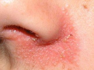 iritație pe pliurile nazolabiale