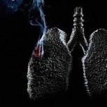Онкологічне захворювання - рак легенів