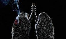 Boala oncologică - cancer pulmonar
