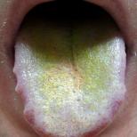 Cauze de placă verde în limba